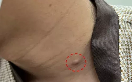 Mụn lâu lành biến thành ung thư