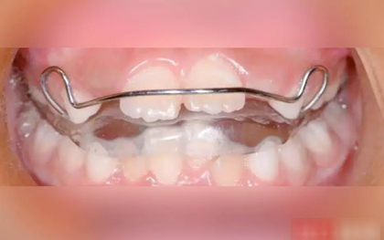 Bé gái 8 tuổi răng hô, môi trên vểnh, cằm nhỏ, trí tuệ giảm vì một thói quen xấu khi ngủ