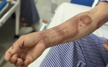 Ba năm mang 'chấm lạ', hai cha con đi khám mới biết mắc bệnh phong