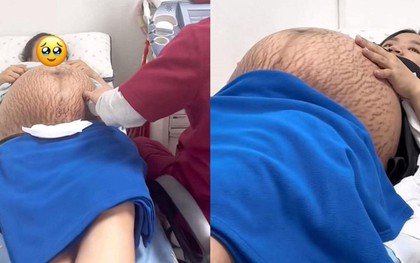 Xót xa hình ảnh chiếc bụng rạn nứt chằng chịt như dưa bở của mẹ bầu thai đôi ở tuần thứ 36