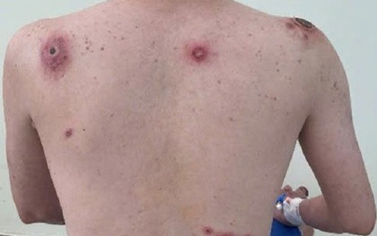 Nam nhân viên văn phòng lở loét toàn thân vì quan hệ tình dục bừa bãi