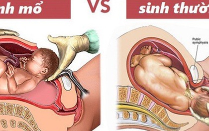 Chọn giờ sinh mổ để được "giờ tốt, ngày tốt": Những rủi ro ít mẹ lường được