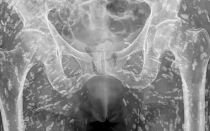 Người đàn ông bị đau hông, bác sĩ phát hiện ra bí mật đáng sợ