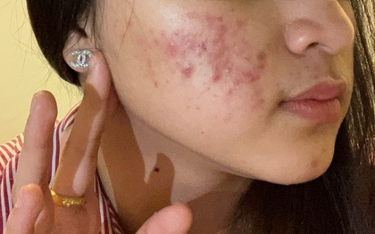 CẢNH BÁO: 4 kiểu mụn rất dễ là "lớp ngụy trang" của bệnh ung thư nhưng ít người để ý