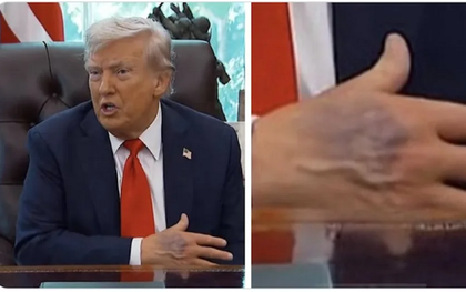 Bàn tay thâm tím của ông Trump gây chú ý