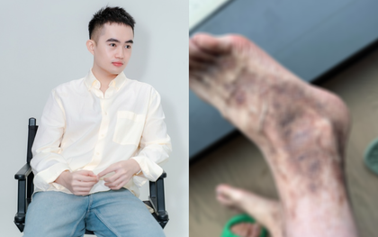 Tina Thảo Thi bị viêm mao mạch hoại tử: "Mỗi lần phát bệnh không đi lại được..."