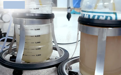 Hút ra gần 30 lít dịch đục "như bùn" từ phổi người đàn ông