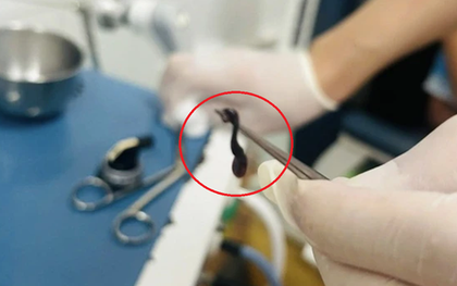 Đau mũi đi khám, bác sĩ sốc nặng khi thấy thứ trong mũi bé trai