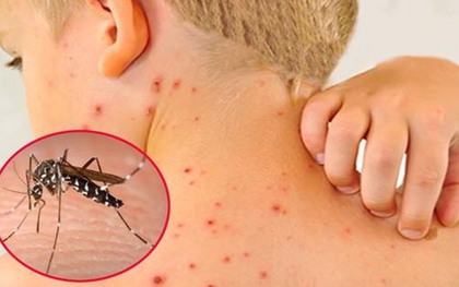 Sốt xuất huyết tăng “nóng” giữa mùa mưa, WHO khuyến nghị tiêm vắc-xin