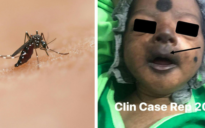 Bé trai 12 ngày tuổi mặt tím đen vì nhiễm virus Chikungunya có thể "phá hủy nội tạng"