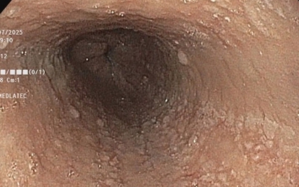 Người phụ nữ đi khám vì nuốt nghẹn, phát hiện 6 bệnh cùng lúc