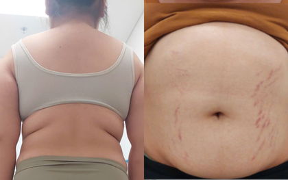 Bé gái 14 tuổi tăng 20kg, lùn đi 6cm vì căn bệnh siêu hiếm