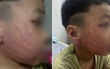 Xôn xao hình ảnh bé trai ở Hà Nội bị đánh tím mặt, phụ huynh phẫn nộ tố đích danh giáo viên
