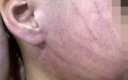 Điều tra vụ bé 4 tuổi nghi bị giáo viên mầm non đánh bầm tím mặt