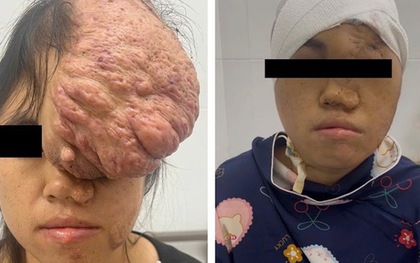 Ngỡ ngàng khuôn mặt cô gái sau 15 năm bị khối u khổng lồ đeo bám