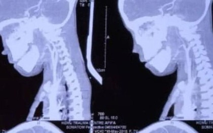 Phẫu thuật cho bé trai 7 tuổi, bác sĩ sốc nặng khi lấy ra "thứ đáng sợ"