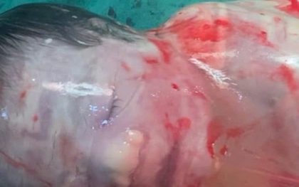 Kỳ diệu bé trai sinh ra trong 'bọc điều' ở Hà Nội, chỉ xuất hiện 1/80.000 ca