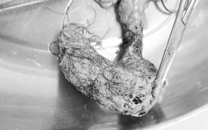 Bé gái 4 tuổi đau bụng, nôn ói, bác sĩ sốc nặng khi phát hiện "thứ đáng sợ" bên trong