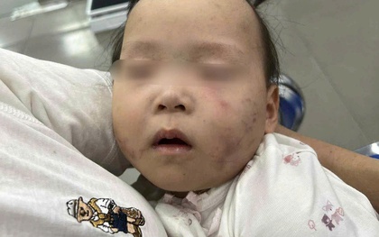 Làm rõ nguyên nhân bé gái bị bầm tím mặt khi gửi ở nhà trẻ Bắc Ninh
