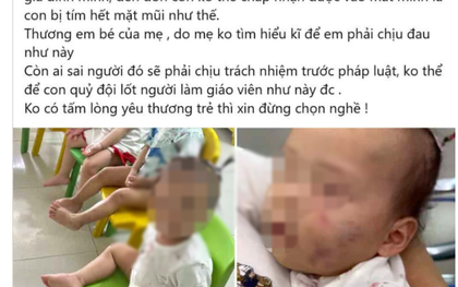Bé gái bị bầm tím mặt sau khoảng 7 tiếng ở nhà trẻ tư thục: Tình trạng sức khoẻ hiện tại