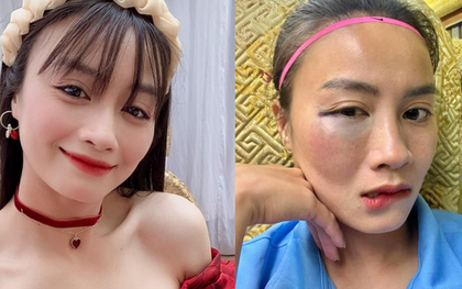 Hotgirl bóng đá Hoàng Thị Loan để lộ vùng mắt sưng vù sau pha va chạm trên sân bóng khiến fan cực xót