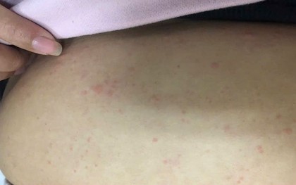 Nguy hiểm từ tự ý dùng thuốc, gia tăng ca sốc phản vệ