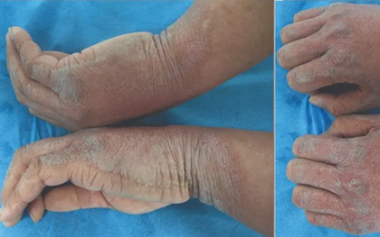 Ca bệnh hiếm gặp khiến bàn tay “lên vảy” mỗi khi rửa nước: bác sĩ cũng lúng túng khi chẩn đoán