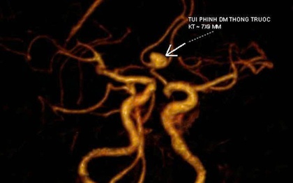 Đau đầu kéo dài, cô gái Hà Nội đi khám phát hiện phình mạch não, suýt đột quỵ