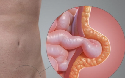 Bé gái quấy khóc vì khối phồng bẹn: Cảnh báo bố mẹ đừng chủ quan