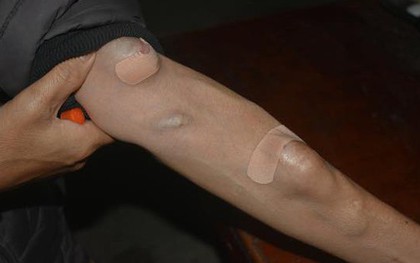 Cánh tay của người chạy thận hóa ra trông thế này: 1 vũ công chuyên mặc áo dài tay 1 bên đã "thức tỉnh" những ai không biết