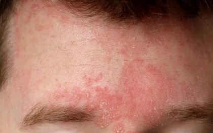 Những bệnh da thường gặp trong mùa lạnh