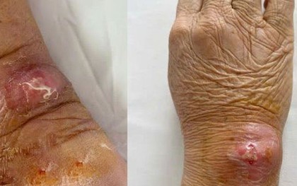 Mắc bệnh dại sau khi bị mèo cào