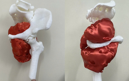 Đau háng kéo dài, người đàn ông bị phát hiện ung thư xương ác tính