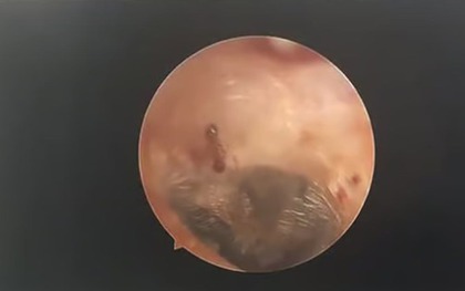 Nghe thấy âm thanh lạ trong tai, người phụ nữ đi khám thì sốc nặng