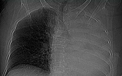 Sặc một viên thuốc, cụ bà xẹp toàn bộ phổi trái