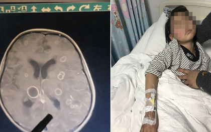 Bé gái lớp 2 não "bị ăn mòn chục lỗ", chậm chút là rỗng hoàn toàn: Thủ phạm rất phổ biến trong mọi gia đình