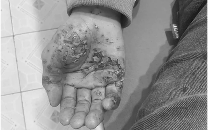 Cảnh báo tai nạn nguy hiểm khi vừa sạc vừa sử dụng điện thoại