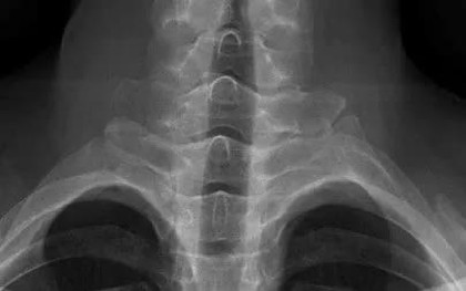 Đau cột sống cổ kéo dài ở người trẻ: Đừng chủ quan với viêm cột sống dính khớp