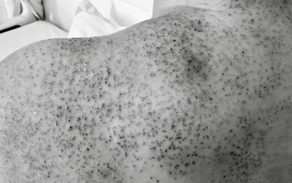 Người phụ nữ nhập viện cấp cứu sau khi chích lể, giác hơi