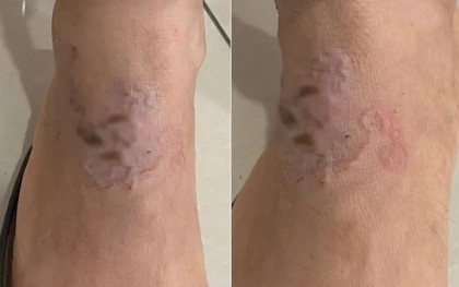 Ấu trùng "vẽ đường" ngoằn ngoèo dưới da người phụ nữ