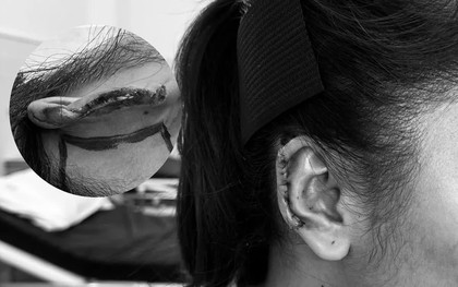 Hành trình tìm lại diện mạo cho người bệnh bị mất vành tai