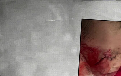 Kinh hoàng giây phút sập trần thạch cao tại 1 trường Mầm non  ở Nghệ An: Mảng trần lớn rơi đúng khu vực ngủ, đè trúng 3 trẻ