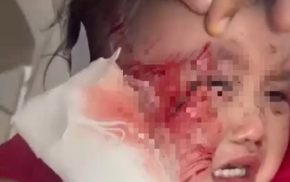 Sập trần thạch cao giờ ngủ trưa, một trẻ mầm non bị thương nặng