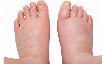 Bàn chân xuất hiện những dấu hiệu này, thận có thể đang 'kêu cứu'