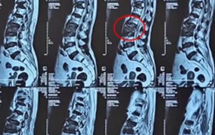 Bơm ‘xi măng’ vào đốt sống cứu cụ bà 100 tuổi