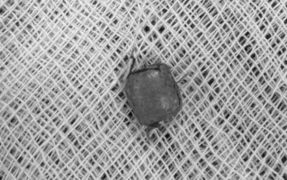 Bé 10 tuổi ù tai kéo dài, bác sĩ lấy ra thứ "đáng sợ" bên trong