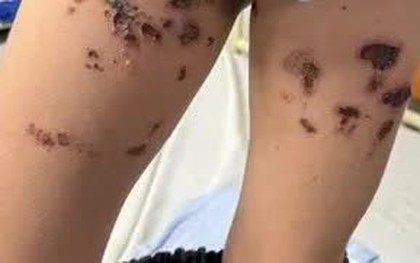 Cảnh báo bỏng hóa chất từ nước tẩy bồn cầu trong gia đình