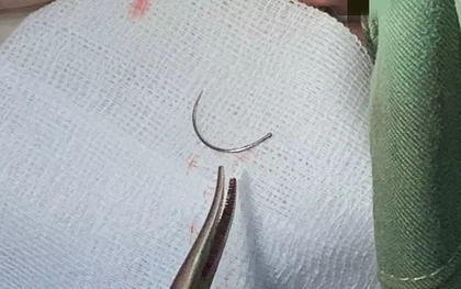 Kim khâu bị ‘bỏ quên’ trong cơ thể người phụ nữ suốt 11 năm