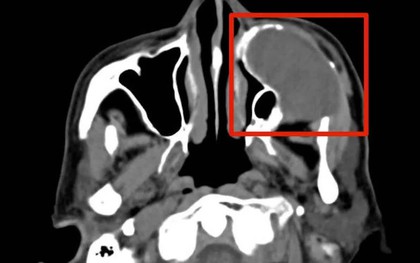 Sự chủ quan khiến khối u âm thầm ăn mòn ổ mắt
