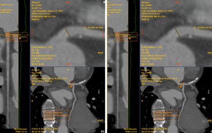 Chỉ đau tức ngực trái thoáng qua, không ngờ phát hiện bệnh lý tim mạch nguy hiểm